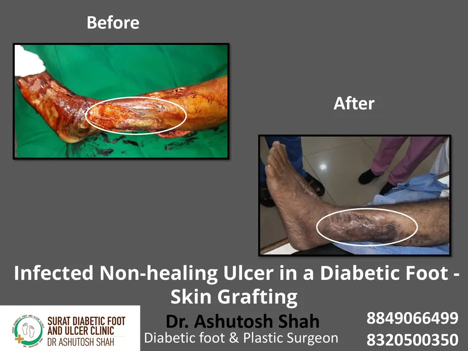 Diabetic Foot  PPT 3 checked by sir.pptx-10.webp